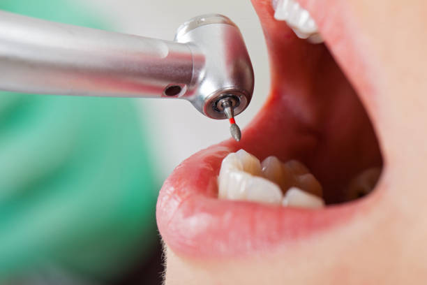 Best Emergency Tooth Extraction in Clayton, DE